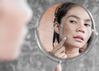 Memasuki Usia 40-an? Ini Cara Menghilangkan Flek Hitam di Wajah