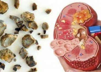 Waspada! Simak 6 Ciri-Ciri Ginjal Anda Kotor