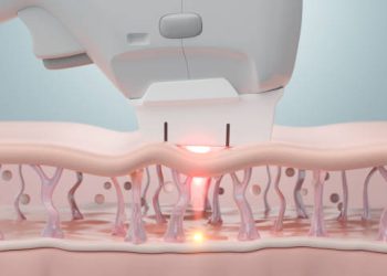 Tanpa Operasi, Ini Teknologi Microneedling dan HIFU yang Bikin Wajah Tampak Muda