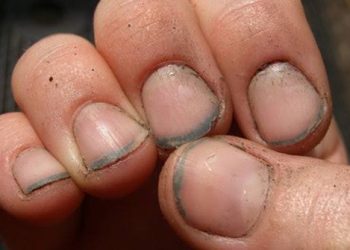 Nutrisi Penting untuk Kuku Agar Kuat, Sehat, dan Tidak Mudah Patah