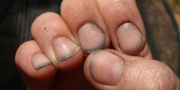 Nutrisi Penting untuk Kuku Agar Kuat, Sehat, dan Tidak Mudah Patah